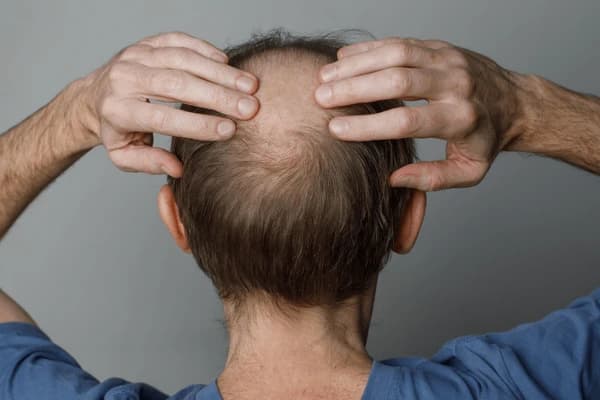 hairfall